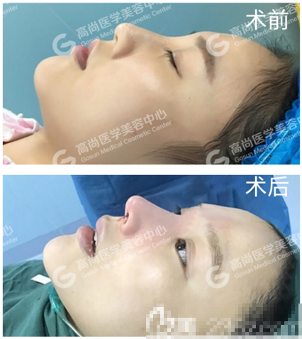 广州高尚余文林院长做的鼻综合隆鼻案例
