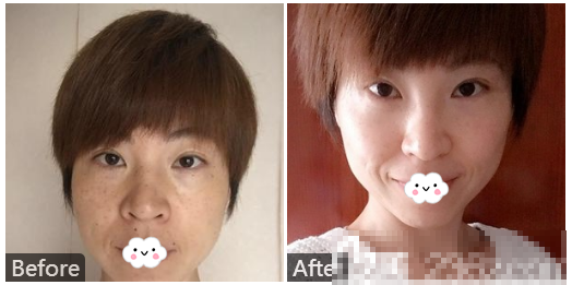 广州澳玛星光医疗美容王冠激光祛斑案例