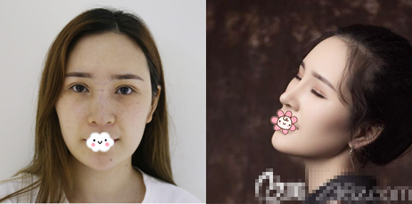 广州紫馨李石峰做的隆鼻子案例