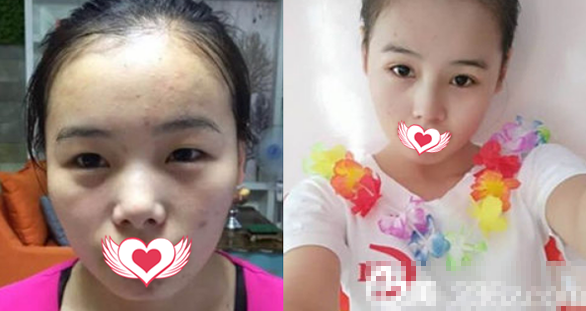 单眼皮女生在安庆增美医疗美容中心做韩式微创双眼皮+假体隆鼻案例
