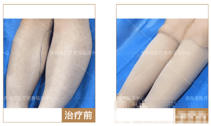 北京杏林美腿部吸脂案例