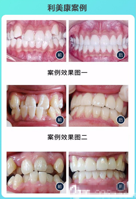 广州利美康口腔医院时代天使隐形牙齿矫正案例