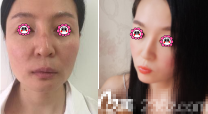 北京黛美医疗美容埋线提升案例