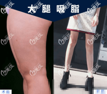 北京丽星翼美大腿吸脂案例
