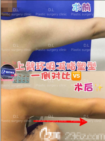 惠州刘伟勇医疗美容诊所刘晓韬做的手臂吸脂案例