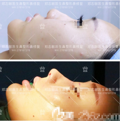 东莞美立方郑志敏自体肋软骨鼻综合修复案例图