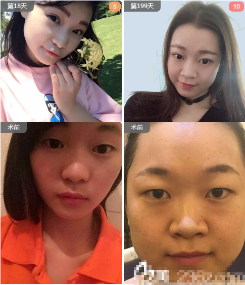 深圳博美医疗美容医院王红玮做的全切双眼皮案例对比图