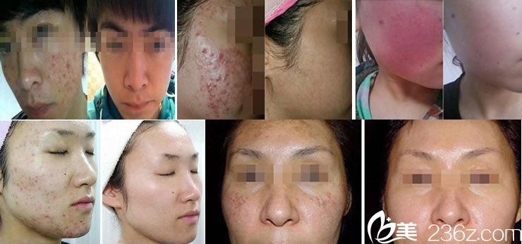 杭州天大皮肤病医院祛痘祛斑案例