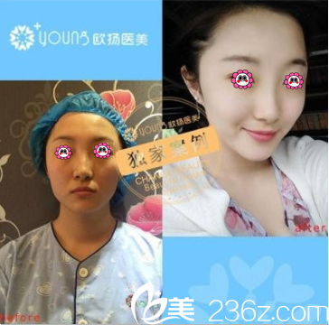 北京欧扬医疗美容医院自体脂肪面部填充案例