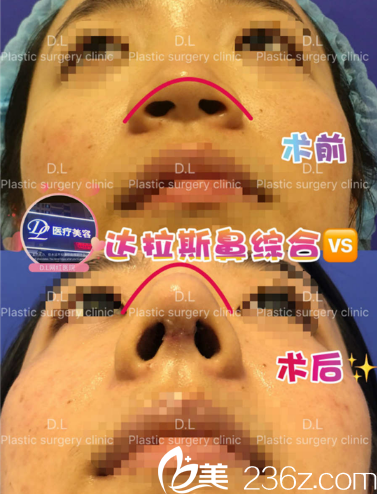 惠州刘伟勇医疗美容诊所整形医生刘伟勇做的隆鼻案例