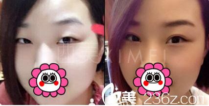北京西美医疗美容吕薇双眼皮上睑吸脂案例
