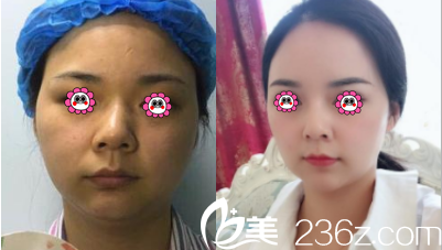 北京黛美医疗美容硅胶隆鼻案例