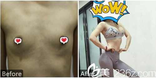 深圳美加美张志勇做的自体脂肪隆胸案例图