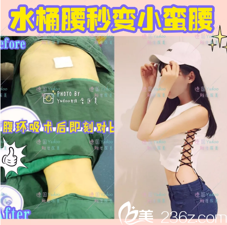 广州雅度医学美容整形医院腰腹部抽脂案例