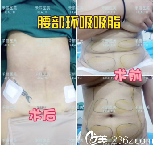 深圳禾丽整形医院腰腹部抽脂案例