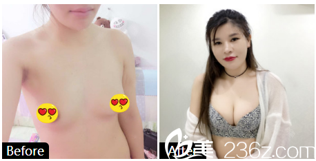 深圳弘美医疗美容整形医院自体脂肪隆胸案例图片