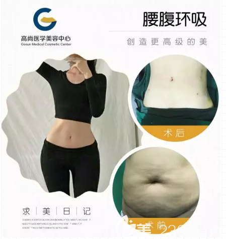 广州高尚医疗美容腰腹部吸脂案例