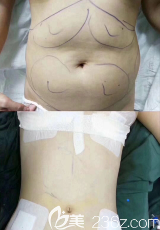 阳江安琪儿医院整形科腰腹部吸脂案例