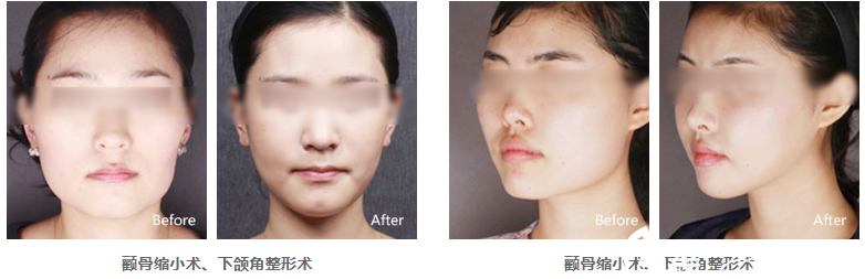 南京海蓝改脸型案例