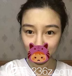 济南木子美容整形医院做的双眼皮开眼角手术案例