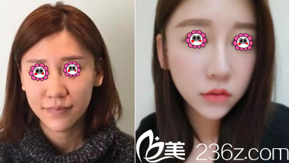 北京黛美医疗美容脸部自体脂肪填充案例
