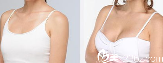 北京亚奇龙医疗整形美容隆胸案例