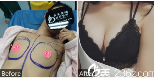 深圳多美美诺医疗美容李帧做的假体隆胸案例