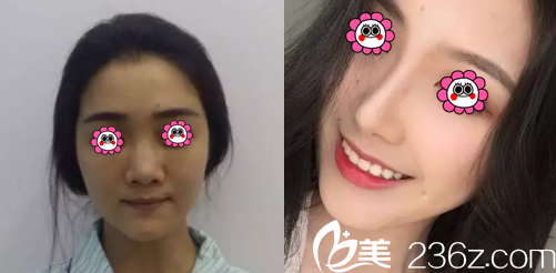 北京亚奇龙医疗整形美容假体隆鼻案例