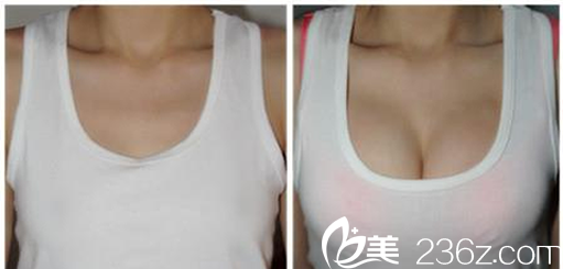 雅美整形自体脂肪隆胸案例术前术后对比图