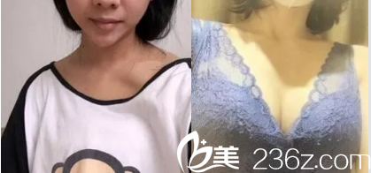 北京艾菲医疗美容自体脂肪隆胸案例