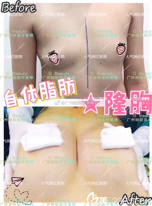 广州姬妍医学美容整形医院自体脂肪隆胸案例