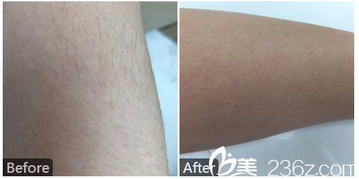 广州澳玛星光医疗美容王冠手臂激光脱毛案例
