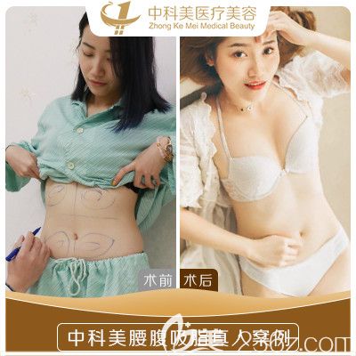 广州中科美邓泳医生做的腰腹部吸脂案例