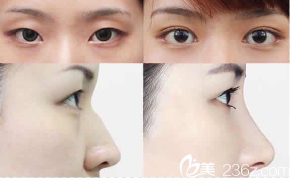 聊城韩美双眼皮和鼻综合隆鼻案例图