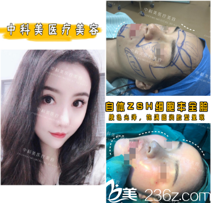 广州中科美医疗美容整形医院郑志敏脂肪填充案例
