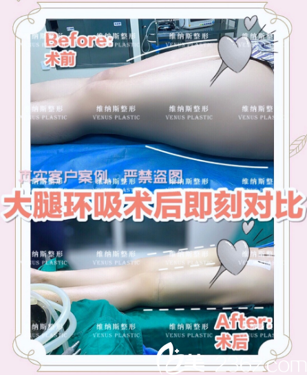 广州维纳斯医疗美容整形医院大腿吸脂案例