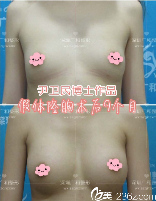 深圳广和整形尹卫民假体隆胸案例对比图