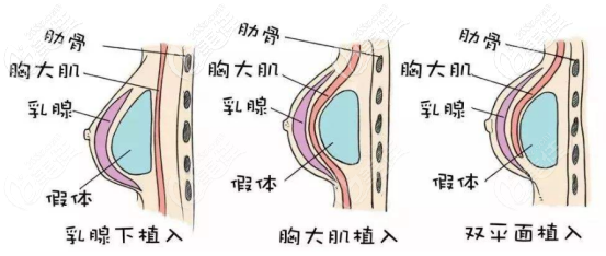 假体放入的层次