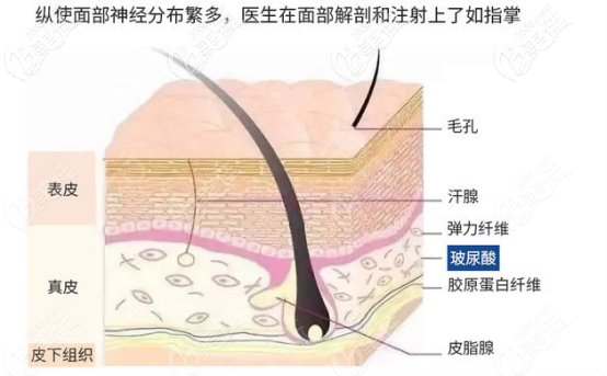 玻尿酸注射的位置