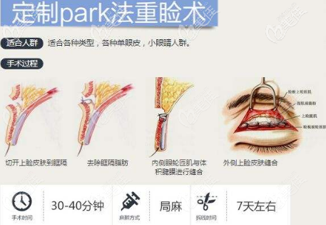 贵阳美莱陈劲PARK法双眼皮术