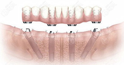All-On-Four半口种植牙技术