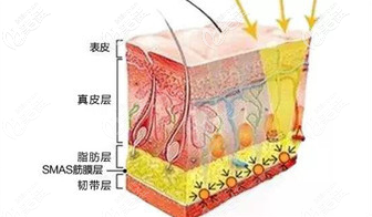 MINI童颜提升术针对的皮肤提升层次示意图