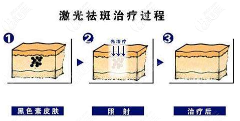 激光祛斑治疗过程图