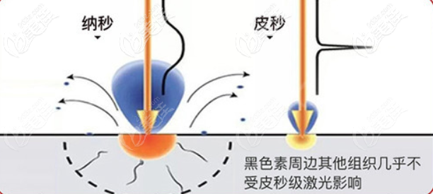 哈尔滨臻美皮秒祛斑优势