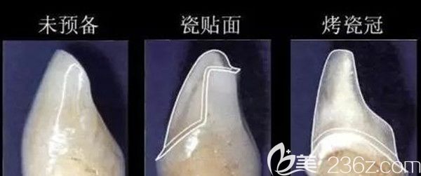 烤瓷牙与瓷贴面的区别