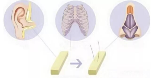 鼻修复方案 半肋鼻修复