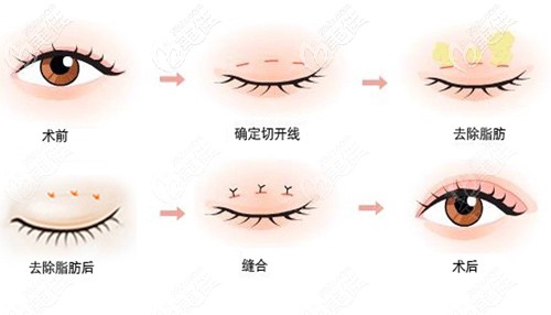 王院长做眼部整形手术示意图