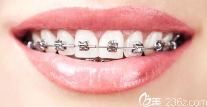 聊城口腔医院高景梅科普：牙周炎顾客可以矫正牙齿吗