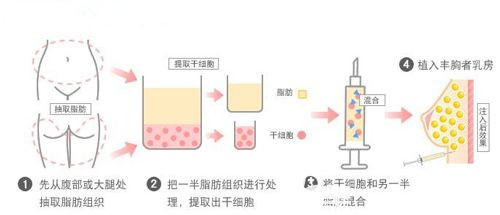 段小兵医生做自体脂肪丰胸手术步骤简易图