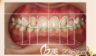 长沙科尔雅口腔陈斌医生解答什么是牙齿美学正畸